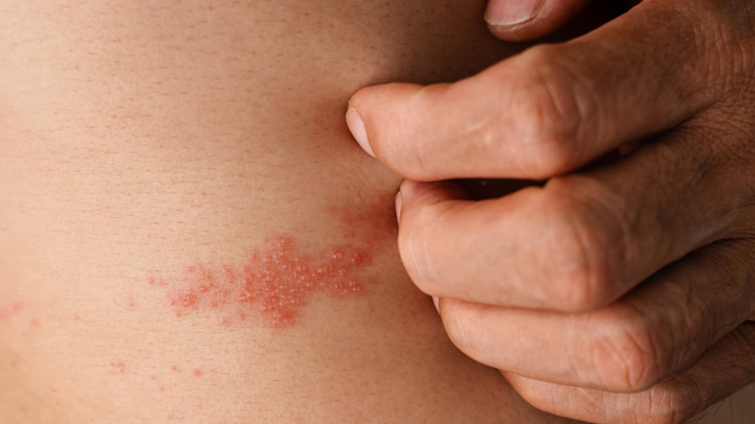 Side view of a rash in shingles on the chest, medical condition, skin reaction.
